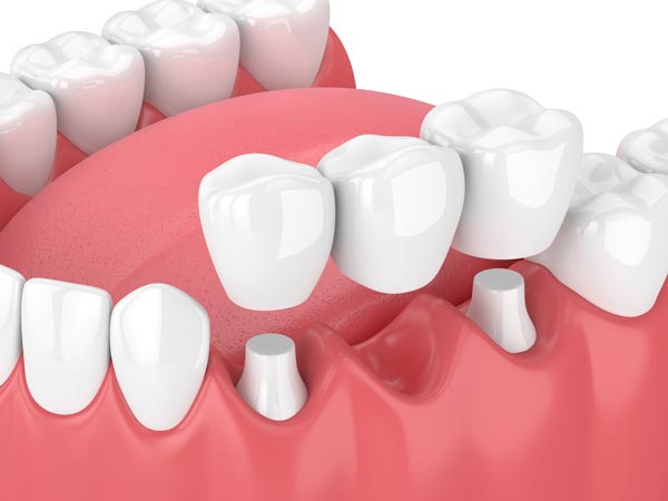 Dental crowns and bridges for Allentown and Whitehall residents