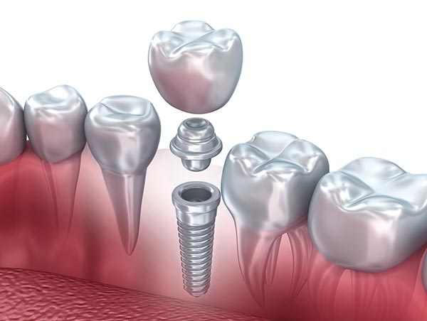 Dental implants in Allentown, Whitehall, Lehigh Valley