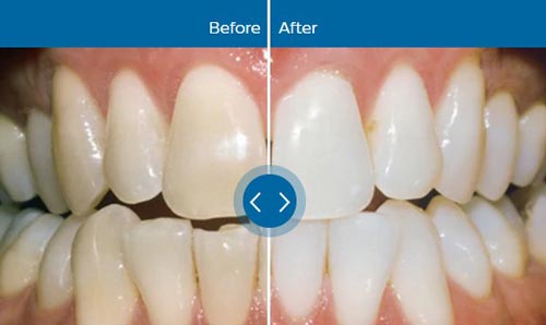 Teeth whitening treatment in Allentown PA with Philips Zoom