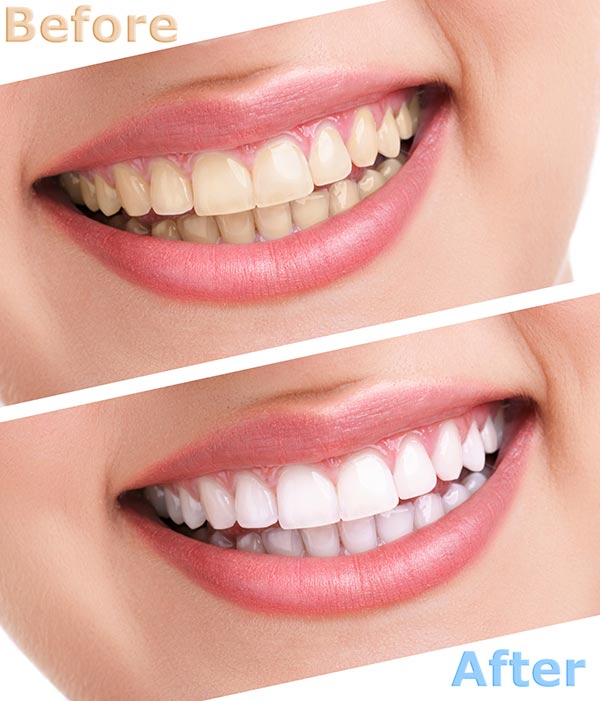 Teeth whitening in Allentown, Lehigh Valley